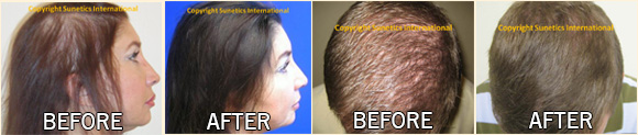 Laser Hair Therapy Before & After