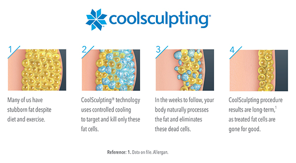 CoolSculpting - How it Works